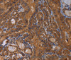 Immunohistochemistry of paraffin-embedded Human thyroid cancer tissue using MAGEB10 Polyclonal Antibody at dilution 1:60