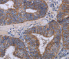 Immunohistochemistry of paraffin-embedded Human colon cancer tissue using MT3 Polyclonal Antibody at dilution 1:50
