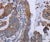 Immunohistochemistry of paraffin-embedded Human esophagus cancer tissue using MT3 Polyclonal Antibody at dilution 1:50