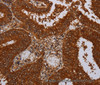 Immunohistochemistry of paraffin-embedded Human colon cancer tissue using MFAP3L Polyclonal Antibody at dilution 1:50