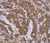 Immunohistochemistry of paraffin-embedded Human liver cancer tissue using MFAP3L Polyclonal Antibody at dilution 1:50
