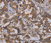 Immunohistochemistry of paraffin-embedded Human liver cancer using REG3G Polyclonal Antibody at dilution of 1:40