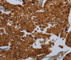Immunohistochemistry of paraffin-embedded Human prostate cancer tissue using ENTPD7 Polyclonal Antibody at dilution 1:60