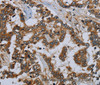 Immunohistochemistry of paraffin-embedded Human liver cancer using MIER2 Polyclonal Antibody at dilution of 1:50