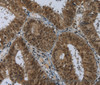 Immunohistochemistry of paraffin-embedded Human colon cancer using MRE11 Polyclonal Antibody at dilution of 1:60