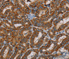 Immunohistochemistry of paraffin-embedded Human thyroid cancer using MRPL28 Polyclonal Antibody at dilution of 1:45