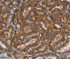 Immunohistochemistry of paraffin-embedded Human thyroid cancer using MRPL39 Polyclonal Antibody at dilution of 1:45