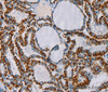 Immunohistochemistry of paraffin-embedded Human thyroid cancer tissue using CMC4 Polyclonal Antibody at dilution 1:55