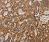 Immunohistochemistry of paraffin-embedded Human thyroid cancer using MTFR1 Polyclonal Antibody at dilution of 1:40