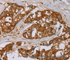 Immunohistochemistry of paraffin-embedded Human breast cancer tissue using MTUS1 Polyclonal Antibody at dilution 1:40