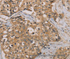 Immunohistochemistry of paraffin-embedded Human breast cancer tissue using NANOS2 Polyclonal Antibody at dilution 1:30