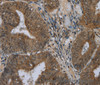 Immunohistochemistry of paraffin-embedded Human colon cancer using NAT10 Polyclonal Antibody at dilution of 1:40