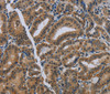 Immunohistochemistry of paraffin-embedded Human thyroid cancer using NAT10 Polyclonal Antibody at dilution of 1:40