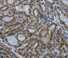 Immunohistochemistry of paraffin-embedded Human thyroid cancer tissue using DAN Polyclonal Antibody at dilution 1:50