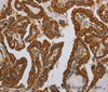 Immunohistochemistry of paraffin-embedded Human thyroid cancer using NDUFS5 Polyclonal Antibody at dilution of 1:50