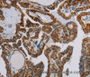 Immunohistochemistry of paraffin-embedded Human thyroid cancer using NDUFS3 Polyclonal Antibody at dilution of 1:30