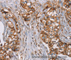 Immunohistochemistry of paraffin-embedded Human breast cancer using NDUFS1 Polyclonal Antibody at dilution of 1:50