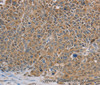 Immunohistochemistry of paraffin-embedded Human ovarian cancer tissue using NDUFS7 Polyclonal Antibody at dilution 1:40
