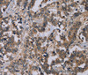 Immunohistochemistry of paraffin-embedded Human liver cancer using NECTIN4 Polyclonal Antibody at dilution of 1:60