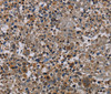 Immunohistochemistry of paraffin-embedded Human lung cancer using NECTIN4 Polyclonal Antibody at dilution of 1:60