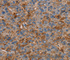Immunohistochemistry of paraffin-embedded Human liver cancer tissue using NEDD4L Polyclonal Antibody at dilution 1:60