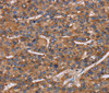 Immunohistochemistry of paraffin-embedded Human liver cancer using NCSTN Polyclonal Antibody at dilution of 1:50