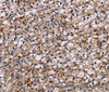 Immunohistochemistry of paraffin-embedded Human prostate cancer using NCSTN Polyclonal Antibody at dilution of 1:50