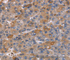 Immunohistochemistry of paraffin-embedded Human liver cancer using NCF2 Polyclonal Antibody at dilution of 1:60
