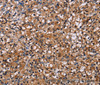 Immunohistochemistry of paraffin-embedded Human prostate cancer using NPM3 Polyclonal Antibody at dilution of 1:60