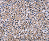Immunohistochemistry of paraffin-embedded Human prostate cancer tissue using NR1D1 Polyclonal Antibody at dilution 1:60