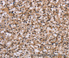 Immunohistochemistry of paraffin-embedded Human prostate cancer using NUP62 Polyclonal Antibody at dilution of 1:50