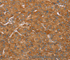 Immunohistochemistry of paraffin-embedded Human liver cancer tissue using PAGE5 Polyclonal Antibody at dilution 1:55