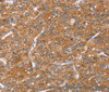 Immunohistochemistry of paraffin-embedded Human liver cancer using PAICS Polyclonal Antibody at dilution of 1:35