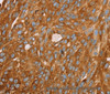 Immunohistochemistry of paraffin-embedded Human breast cancer using PAICS Polyclonal Antibody at dilution of 1:35