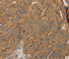 Immunohistochemistry of paraffin-embedded Human breast cancer tissue using PARP11 Polyclonal Antibody at dilution 1:30