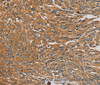 Immunohistochemistry of paraffin-embedded Human lung cancer tissue using PARP11 Polyclonal Antibody at dilution 1:30