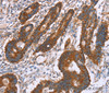 Immunohistochemistry of paraffin-embedded Human colon cancer using CLP36 Polyclonal Antibody at dilution of 1:30