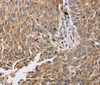 Immunohistochemistry of paraffin-embedded Human lung cancer tissue using PDLIM7 Polyclonal Antibody at dilution 1:35