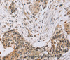 Immunohistochemistry of paraffin-embedded Human esophagus cancer tissue using PDLIM7 Polyclonal Antibody at dilution 1:35