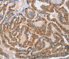 Immunohistochemistry of paraffin-embedded Human thyroid cancer using MSMB Polyclonal Antibody at dilution of 1:30