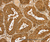 Immunohistochemistry of paraffin-embedded Human cervical cancer tissue using PDP1 Polyclonal Antibody at dilution 1:30