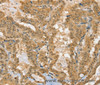 Immunohistochemistry of paraffin-embedded Human thyroid cancer using PSMC1 Polyclonal Antibody at dilution of 1:40
