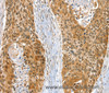 Immunohistochemistry of paraffin-embedded Human esophagus cancer using RAB27A Polyclonal Antibody at dilution of 1:30