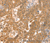 Immunohistochemistry of paraffin-embedded Human breast cancer using RPS6KA1 Polyclonal Antibody at dilution of 1:30