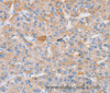Immunohistochemistry of paraffin-embedded Human liver cancer using SLC25A13 Polyclonal Antibody at dilution of 1:35