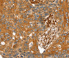 Immunohistochemistry of paraffin-embedded Human esophagus cancer tissue using TAGLN Polyclonal Antibody at dilution 1:30