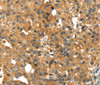 Immunohistochemistry of paraffin-embedded Human breast cancer tissue using SMYD4 Polyclonal Antibody at dilution 1:40