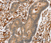Immunohistochemistry of paraffin-embedded Human colon cancer using SSX2IP Polyclonal Antibody at dilution of 1:45
