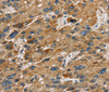 Immunohistochemistry of paraffin-embedded Human liver cancer using SULT1B1 Polyclonal Antibody at dilution of 1:30