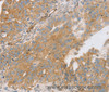 Immunohistochemistry of paraffin-embedded Human breast cancer using STX16 Polyclonal Antibody at dilution of 1:30